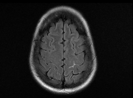 Une céphalée en coup de tonnerre l Institut de radiologie Paris