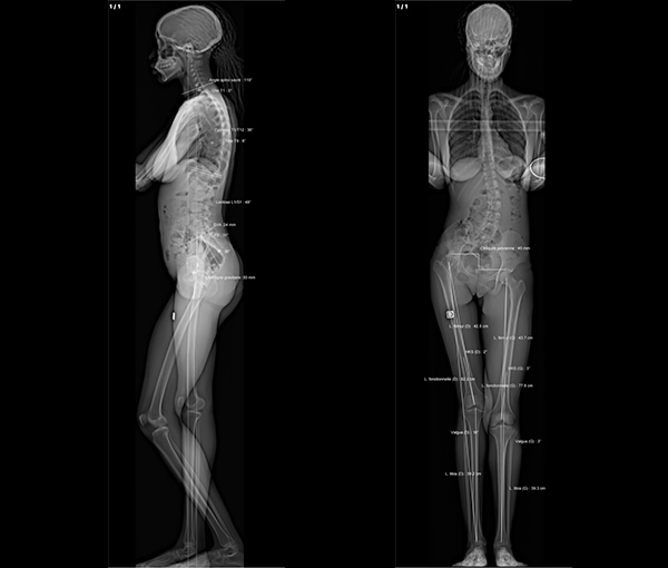 Radiographie EOS - examens d'imagerie l Institut de radiologie de Paris