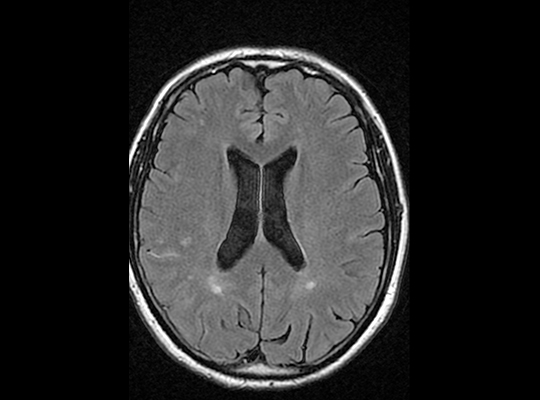 Cas clinique : Troubles cognitifs et déficit transitoire l Institut de radiologie de Paris