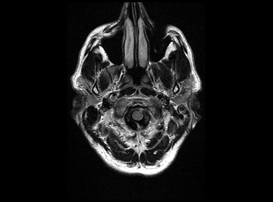 Céphalée aiguë et ptosis l Cas clinique de l'institut de radiologie de Paris