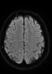 Cas clinique : Troubles cognitifs et déficit transitoire