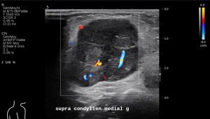 Le rôle de l’imagerie dans le suivi et la surveillance des mélanomes l Institut de radiologie de Paris