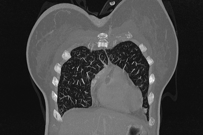 Imagerie du thorax - imagerie du poumon l Institut de radiologie de Paris