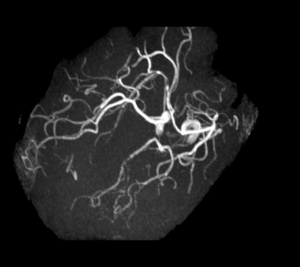 Cas clinique : Céphalée aiguë et ptosis l Institut de radiologie de Paris