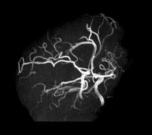 Cas clinique : Céphalée aiguë et ptosis l Institut de radiologie de Paris