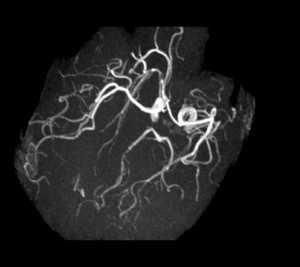 Cas clinique : Céphalée aiguë et ptosis l Institut de radiologie de Paris