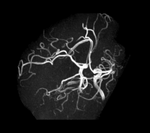 Cas clinique : Céphalée aiguë et ptosis l Institut de radiologie de Paris