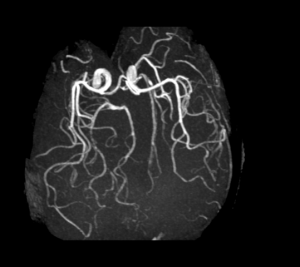 Cas clinique : Céphalée aiguë et ptosis l Institut de radiologie de Paris