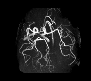 Cas clinique : Céphalée aiguë et ptosis l Institut de radiologie de Paris