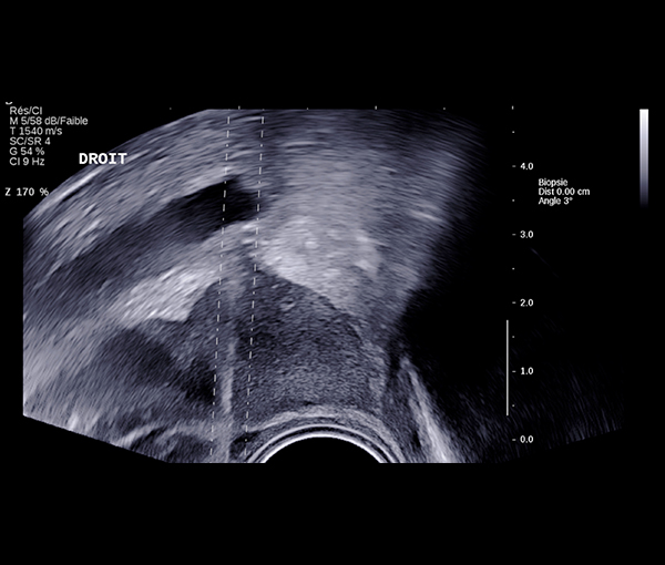 Biopsie prostatique, imagerie de la prostate l Institut de radiologie de Paris