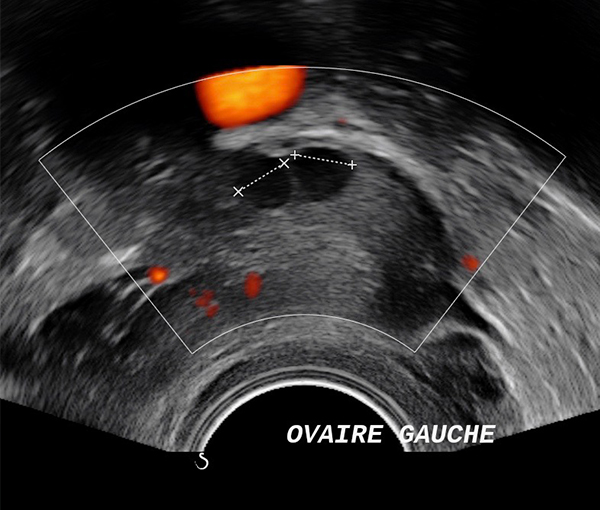 Imagerie utérus et ovaires - imagerie de la femme l Institut de radiologie de Paris