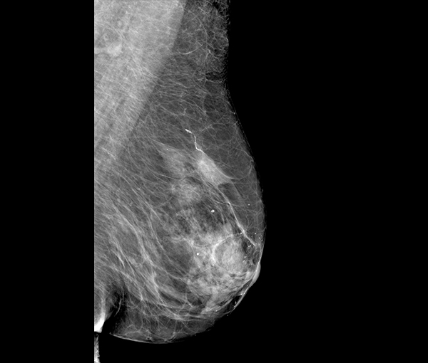 Mammographie - imagerie de la femme l Institut de radiologie de Paris