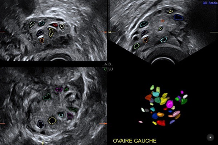 Imagerie utérus et ovaires - imagerie de la femme l Institut de radiologie de Paris