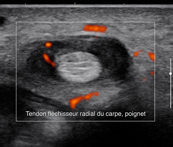 Echographie Doppler - examen d'imagerie l Institut de radiologie de Paris