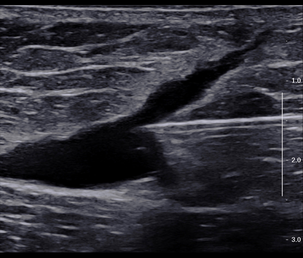 Echographie Doppler - examen d'imagerie l Institut de radiologie de Paris