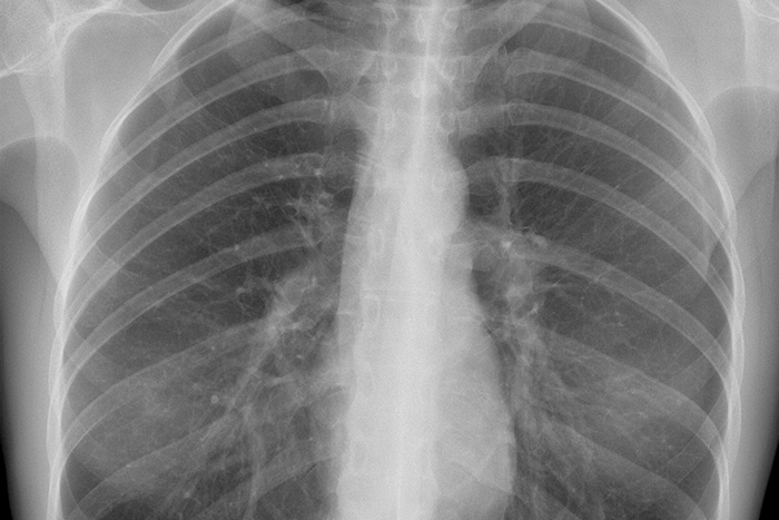 Imagerie du thorax - imagerie du poumon l Institut de radiologie de Paris