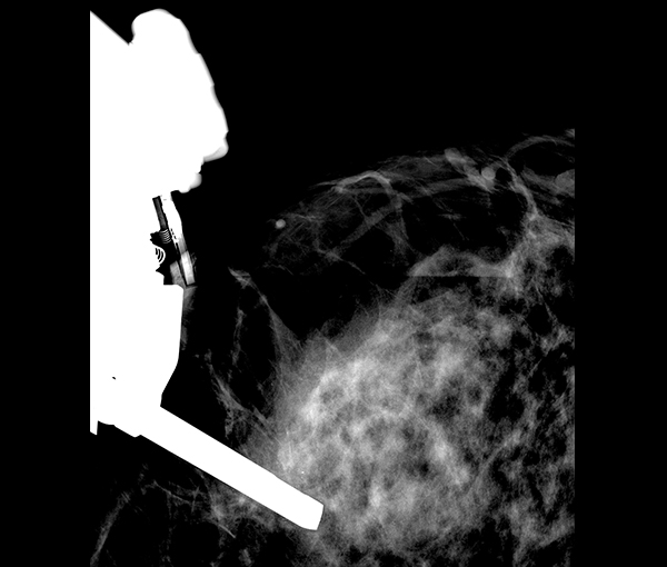 Biopsie et ponction du sein et des ganglions axiliaires l Institut de radiologie de Paris