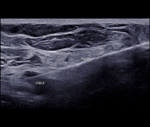 Biopsie et ponction du sein et des ganglions axiliaires l Institut de radiologie de Paris