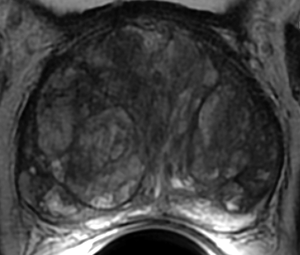 Biopsie prostatique, imagerie de la prostate l Institut de radiologie de Paris