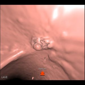 Coloscopie virtuelle : dépistage cancer colorectal l Institut de Radiologie de Paris
