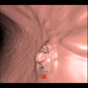 Coloscopie virtuelle : dépistage cancer colorectal l Institut de Radiologie de Paris