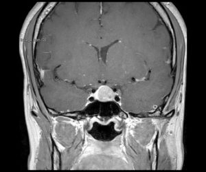 Nouvelle IRM 3T l Institut de radiologie de Paris