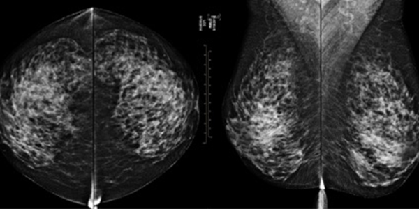 Intelligence artificielle cancer du sein l Institut de radiologie de Paris