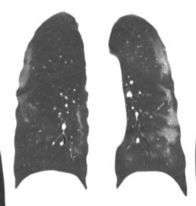 Cas clinique de pneumopathie infectieuse par SARS Cov 2 (COVID-19)