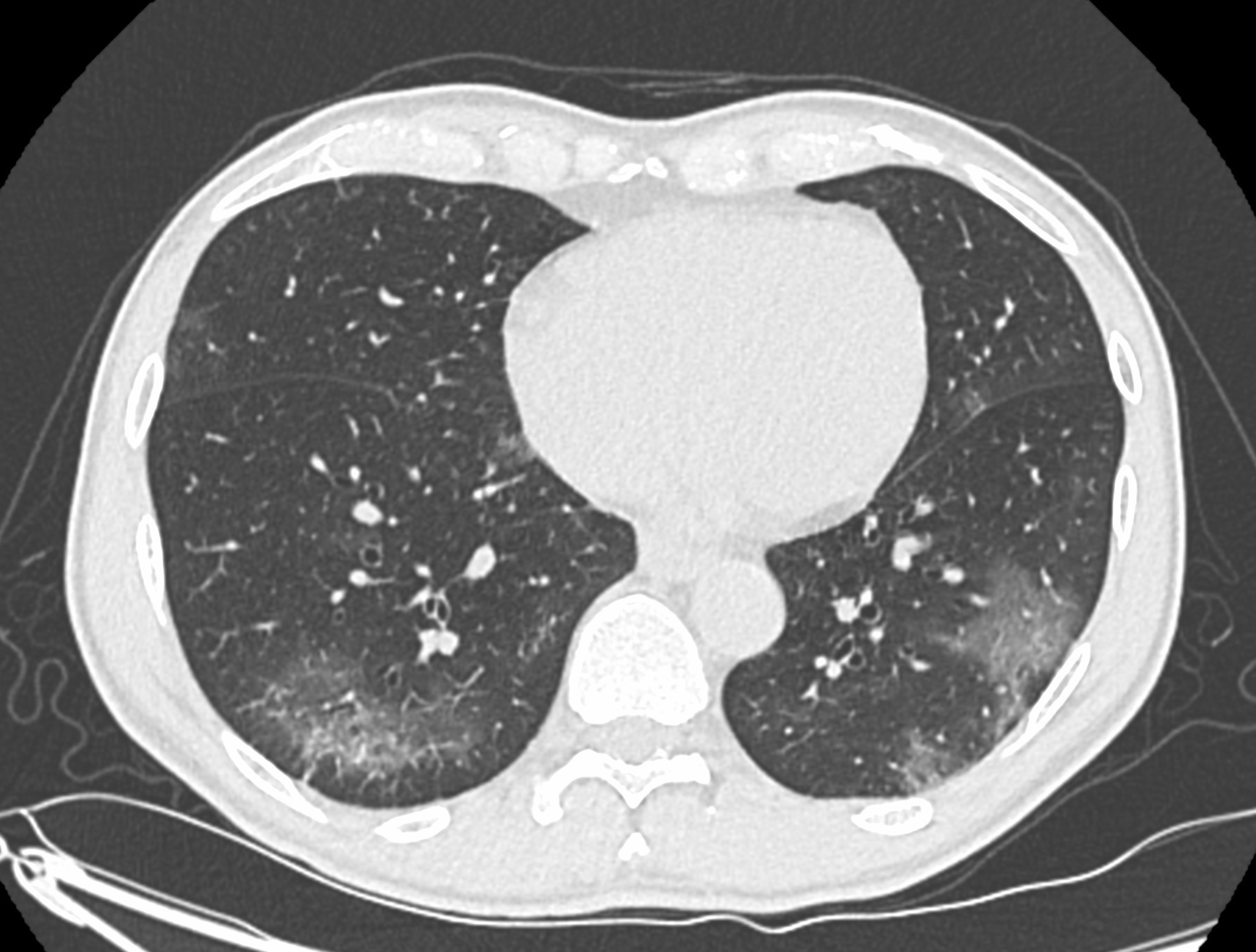 Cas clinique de pneumopathie infectieuse par SARS Cov 2 (COVID-19)