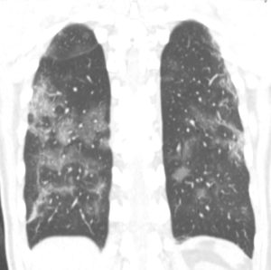 Cas clinique de pneumopathie infectieuse par SARS Cov 2 (COVID-19)