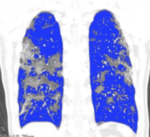 Cas clinique de pneumopathie infectieuse par SARS Cov 2 (COVID-19)