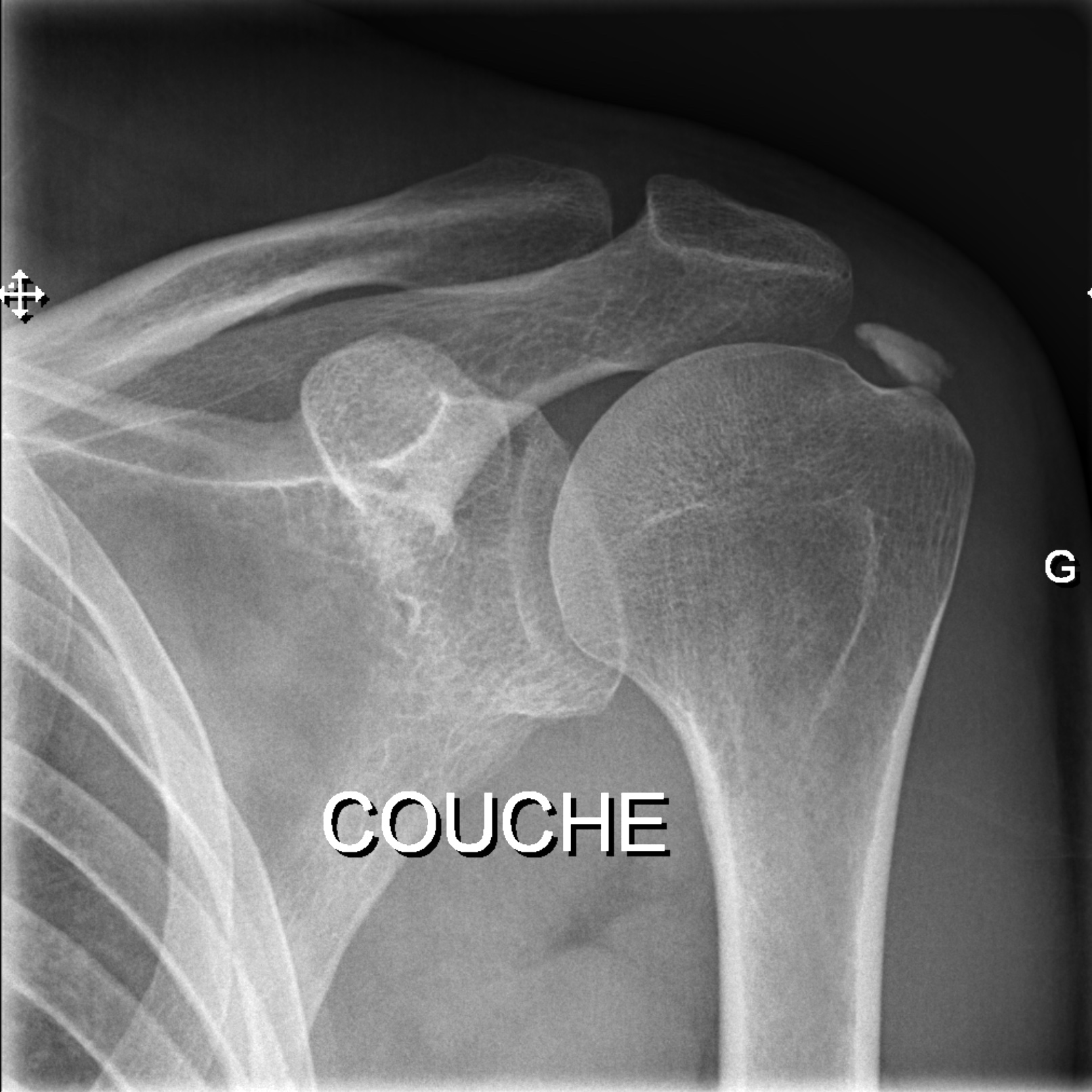 Infiltrations de l'épaule guidées par l'imagerie l Institut de