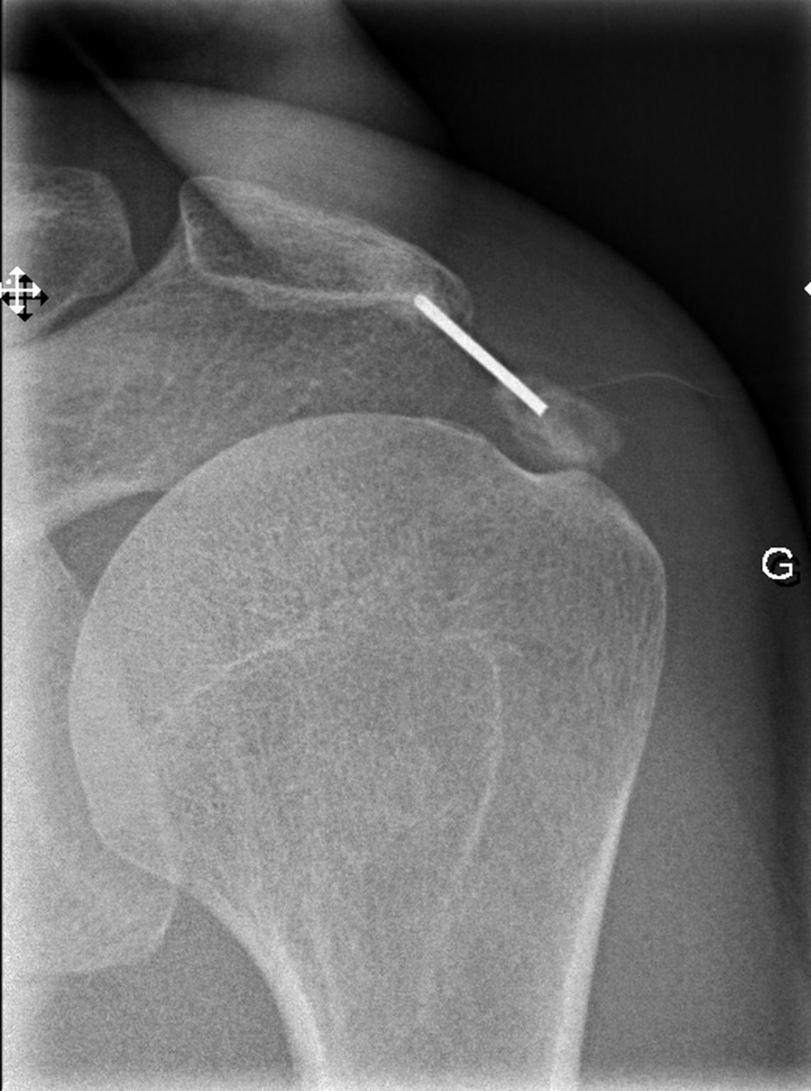 Infiltrations de l'épaule guidées par l'imagerie l Institut de