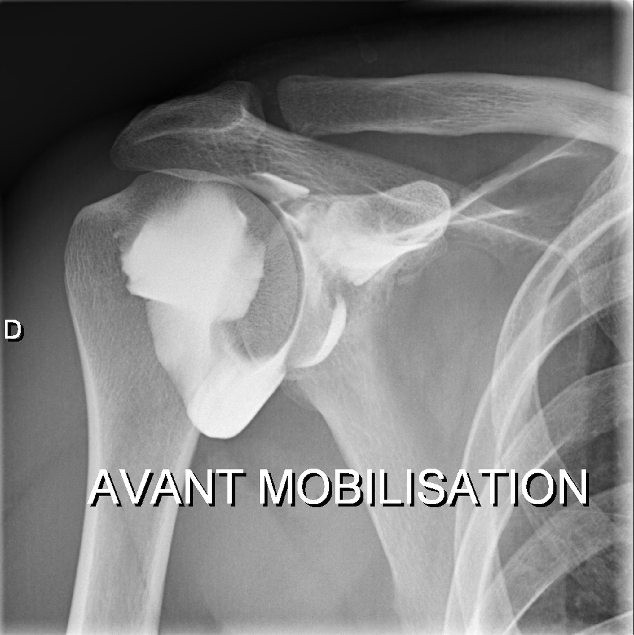 Infiltrations de l'épaule guidées par l'imagerie l Institut de