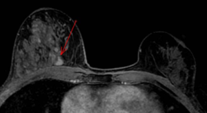 Radio du sein : dépistage (flèche rouge)