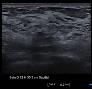 Radiographie du sein 